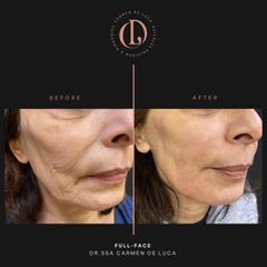 Filler - Carmen De Luca Chirurgia e Medicina Estetica