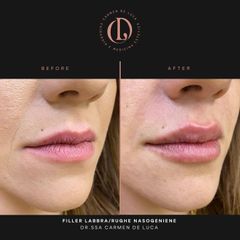 Filler labbra - Carmen De Luca Chirurgia e Medicina Estetica