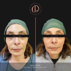 Filler - Carmen De Luca Chirurgia e Medicina Estetica