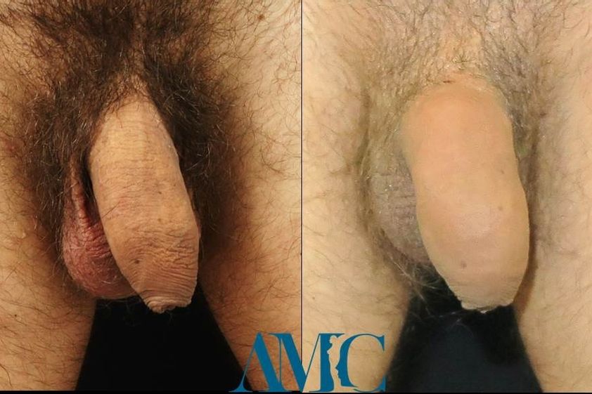 Allungamento pene prima e dopo - 769297