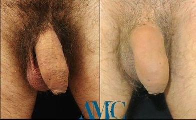 allungamento pene prima e dopo