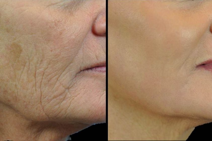 Laserterapia prima e dopo - 769304