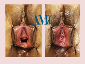 Ringiovanimento vaginale laser prima e dopo - 769306