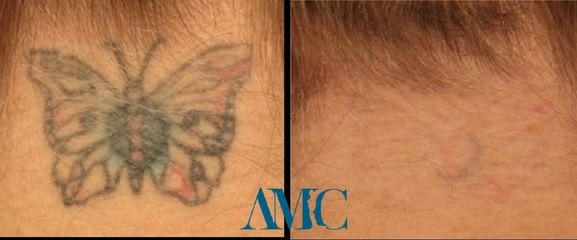 Rimozione tatuaggi prima e dopo
