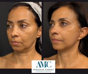 Dott. Aurelio M. Cardaci Lifting Viso