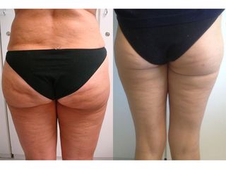 Lipofilling prima e dopo