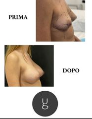 Mastoplastica additiva - Dr Uberto Giovannini