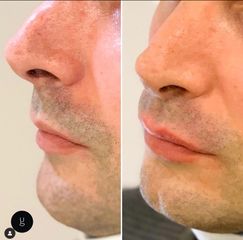 Filler labbra  - Dr Uberto Giovannini