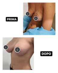 Mastoplastica additiva - Dr Uberto Giovannini