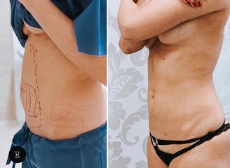 Liposuzione  - Dr Uberto Giovannini