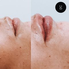 Filler labbra  - Dr Uberto Giovannini