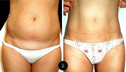 Liposuzione  - Dr Uberto Giovannini