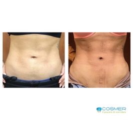 Liposuzione - Poliambulatorio Cosmer Torino