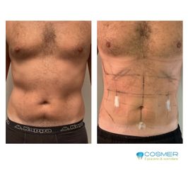 Liposuzione - Poliambulatorio Cosmer Torino