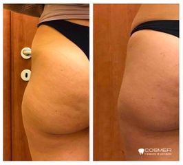 Liposuzione - Poliambulatorio Cosmer Torino