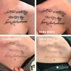 Rimozione tatuaggi - Poliambulatorio Cosmer Torino