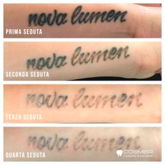 Rimozione tatuaggi - Poliambulatorio Cosmer Torino