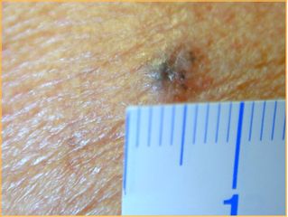 Tumore pigmentato della pelle