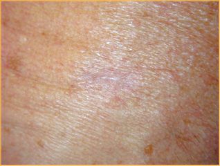 Aspetto della pelle dopo l'asportazione del tumore pigmentato