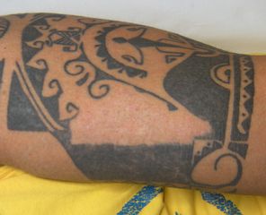 Tatuaggio monocromatico nero dopo rimozione laser parziale