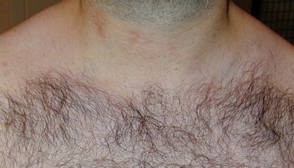 Laserepliazione su petto e collo maschile