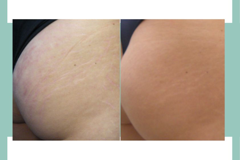 Smagliature prima e dopo - 812804