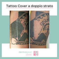 Tatto cover a doppio strato - Dr. Florian Clemens Heydecker