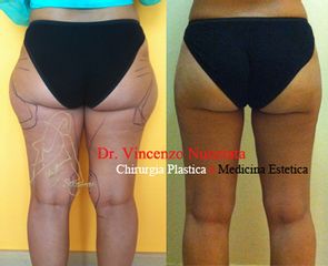 Liposuzione prima e dopo