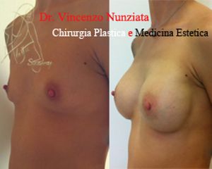 Mastoplastica additiva prima e dopo