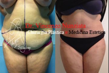 addominoplastica con liposuzione