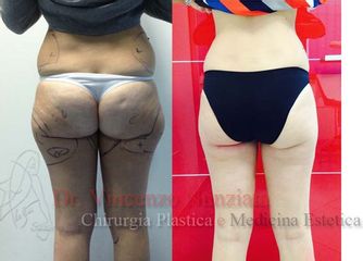 Liposcultura pre e post