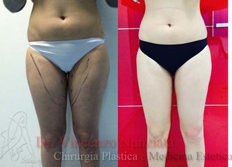 Liposcultura prima e dopo