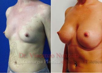 Mastoplastica additiva prima e dopo