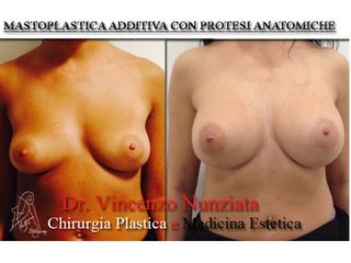 Aumento del seno prima e dopo