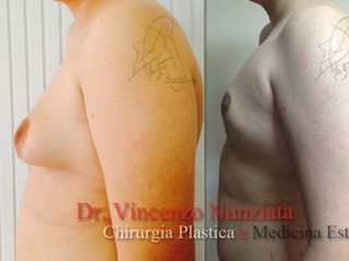 Ginecomastia prima e dopo
