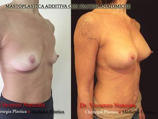 Mastoplastica additiva prima e dopo