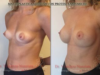 Mastoplastica additiva prima e dopo