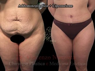 Addominoplastica prima e dopo