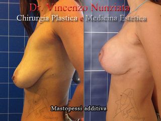 lifting seno prima e dopo