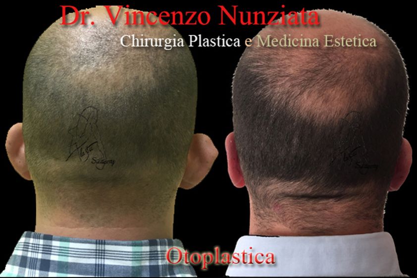 Otoplastica prima e dopo - 759732