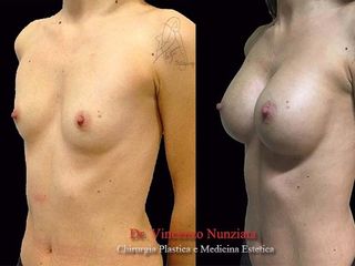 Mastoplastica dual plane prima e dopo