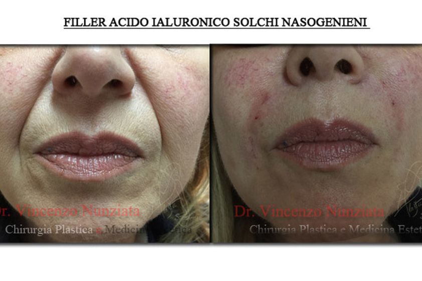 Acido ialuronico prima e dopo - 762011