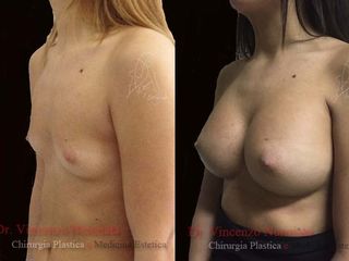 Mastoplastica prima e dopo