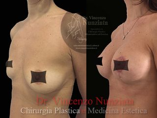 Asimmetria Mammaria prima e dopo