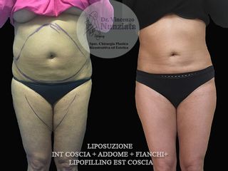Lipofilling e Liposuzione prima e dopo