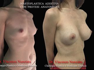 Mastoplastica prima e dopo