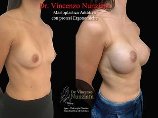 Mastoplastica additiva prima e dopo