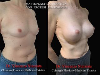 Mastoplastica additiva prima e dopo