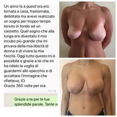 Mastopessi con protesi prima e dopo