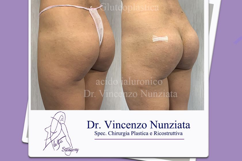 Gluteoplastica prima e dopo - 771269
